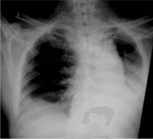 Hemosorption carried out by a column filled with hypercrosslinked styrene-divinibenzene copolymer with an immobilized LPS-selective ligand in a complex of intensive treatment of acute lung injury in the surgical treatment of lung cancer (clinical observation)